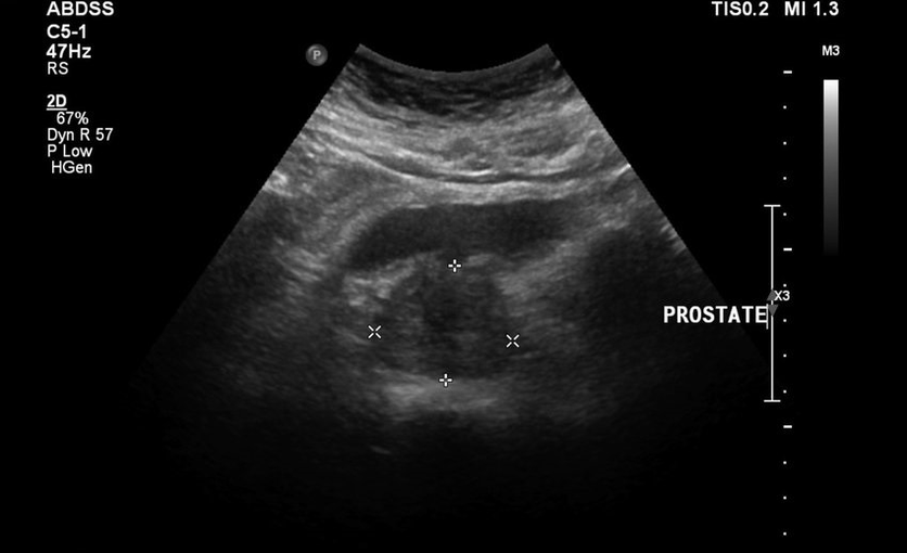 Prostatitis por ultrasonido antes de tomar zxcvbnmqwert