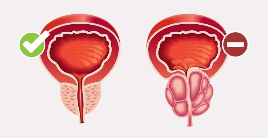 Prostatitis en hombres