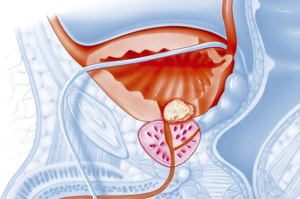prostatitis