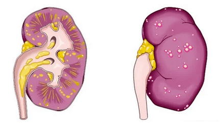 ¿Qué es la prostatitis aguda