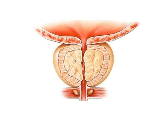 Aumento de la próstata con prostatitis