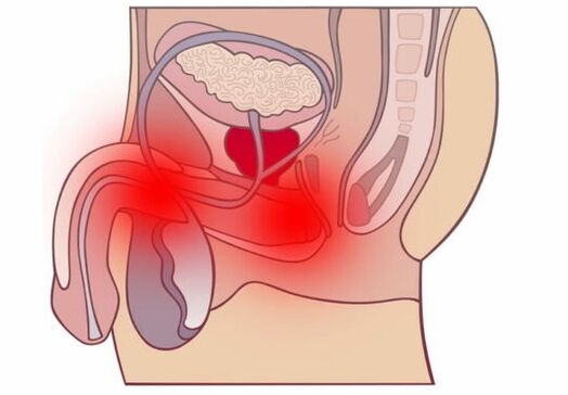 Prostatitis aguda