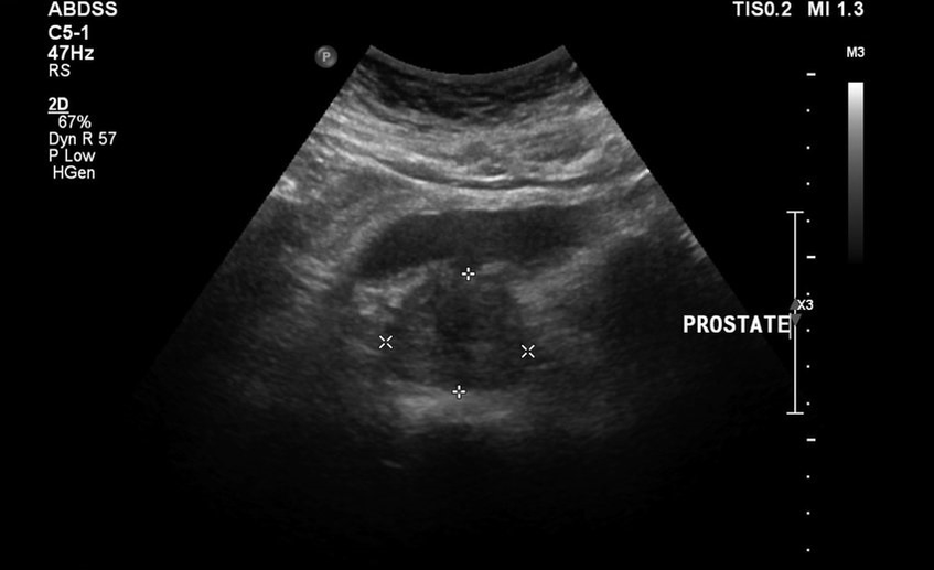 prostatitis para ultrasonido antes de tomar Urosaf